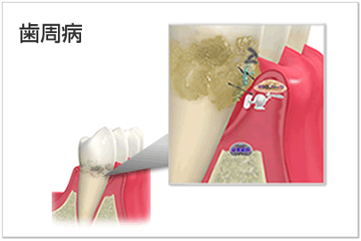 歯周病